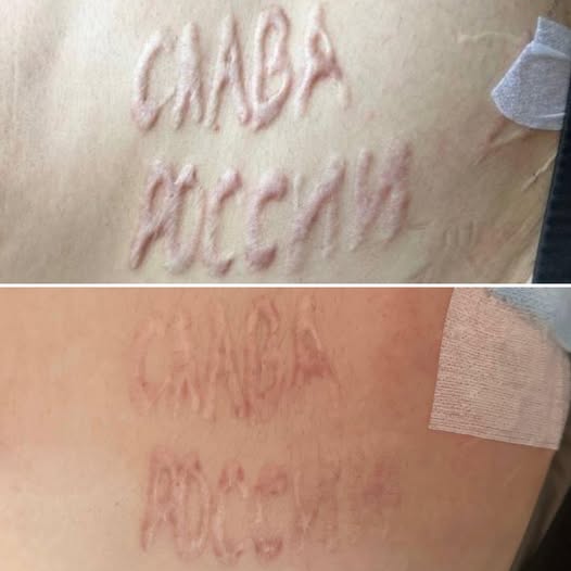 Лікар показав прогрес у лікуванні військового, якому в полоні випалили напис на тілі